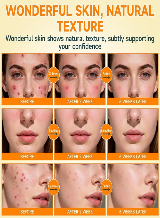 CHANGARLOAD 14% Azelaic Acid Acne Cream - Dark Spot Remover for Face, Acne Treatment & Acne Spot Treatment Salicylic Acid & Niacinamide – Redness Reducing Skin Care,Evens Tone & Soothe Irritation & Rosacea，1oz - Image 5